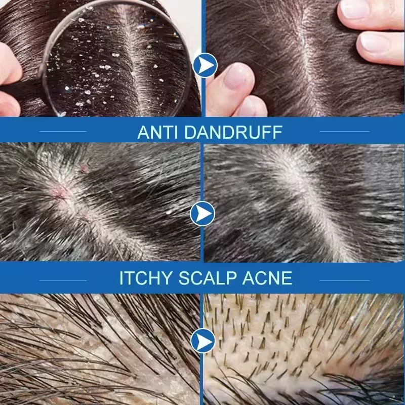 Sabonete de tratamento capilar - Hair Care Dandruff avaliação e preço